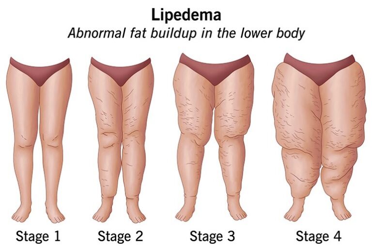 lipedema