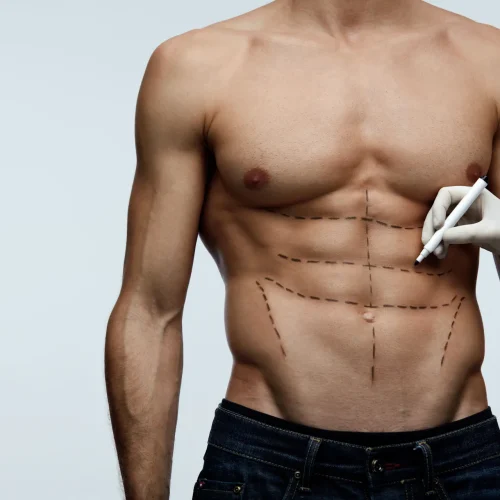 vaser lipo vaser lipo